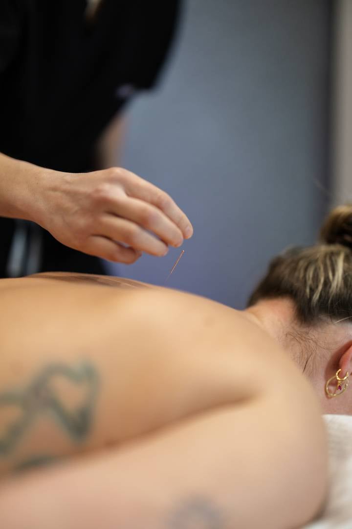 Acupuncture needle being inserted into the back